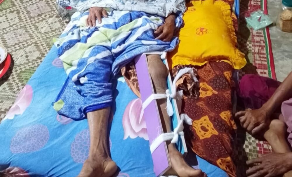 Syukri pasien patah tulang Aceh Utara